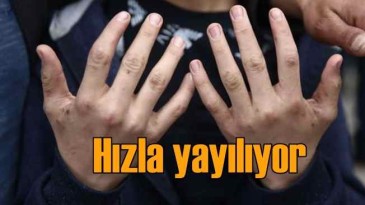 Sağlık Bakanlığı’ndan ‘uyuz’ uyarısı!