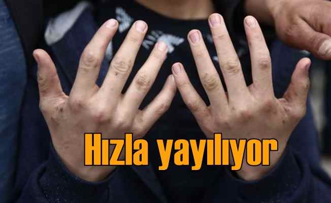 Sağlık Bakanlığı’ndan ‘uyuz’ uyarısı!