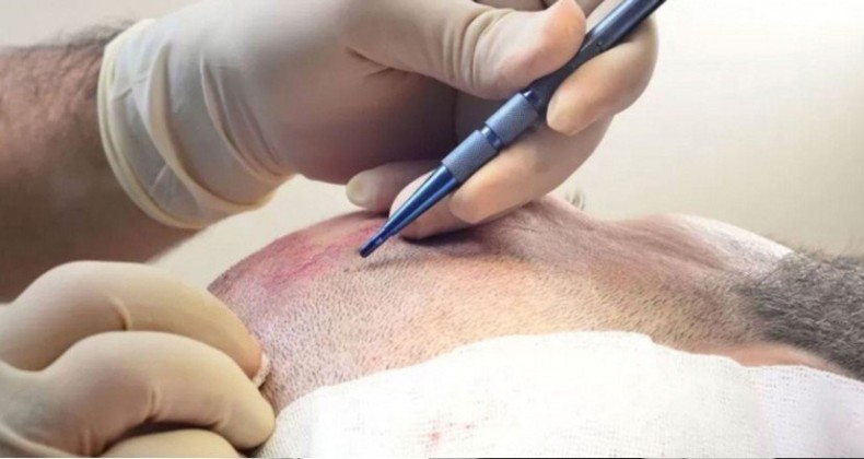 Saç ekimi ölüme götürdü! Soruşturma başlatıldı…